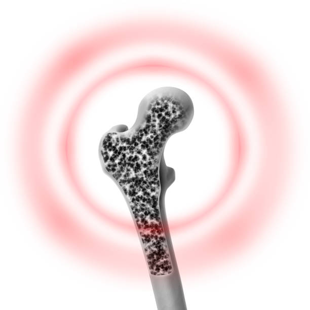 ¿CÓMO PUEDO PREVENIR E INCLUSO REVERTIR MI OSTEOPOROSIS?