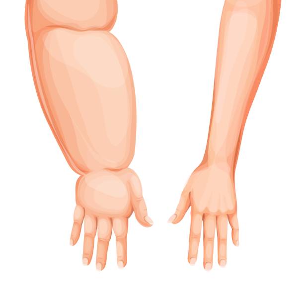 EJERCICIO Y LINFEDEMA.